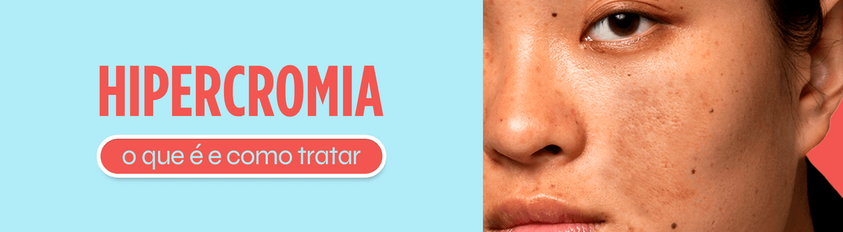 Hipercromia: O que é e como tratar