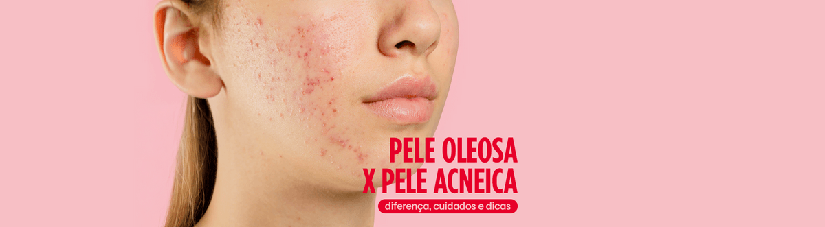 Pele Oleosa x Pele Acneica: Diferença, Cuidados & Dicas